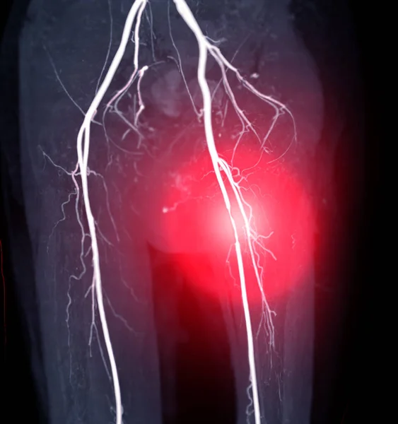 CTA femoral artery run off image of femoral artery for diagnostic  Acute or Chronic Peripheral Arterial Disease.