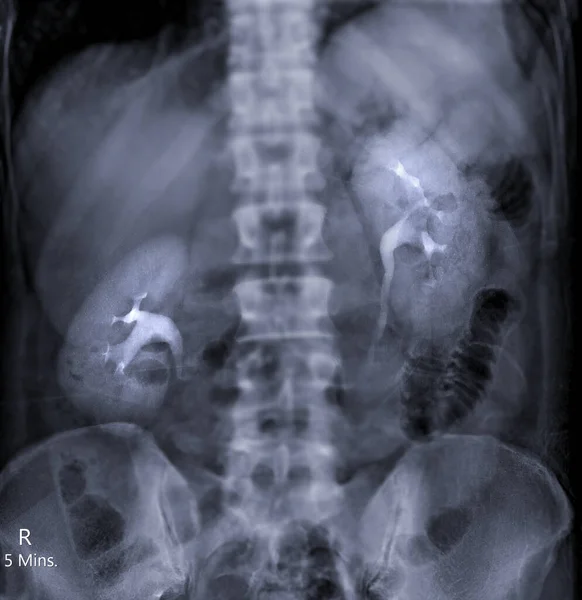 Внутривенная Пиелограмма Рентгенологическое Исследование Мочевыводящих Путей После Инъекции Контрастного Вещества — стоковое фото