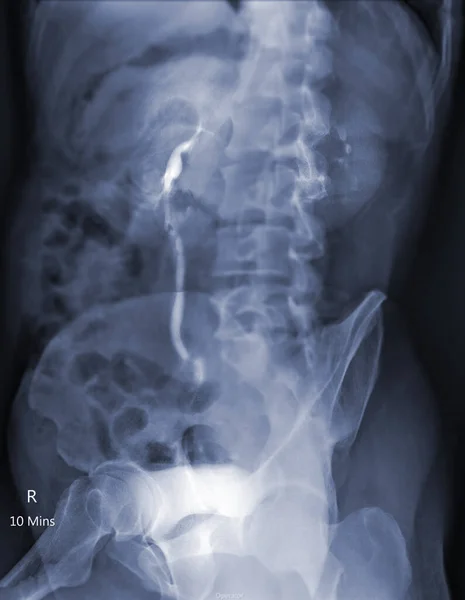 Intraveneus Pyelogram Een Röntgenonderzoek Van Urinewegen Injectie Contrast Media Agent — Stockfoto
