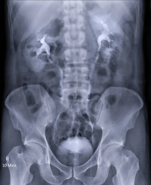Pielograma Intravenoso Examen Rayos Del Tracto Urinario Después Del Medio — Foto de Stock