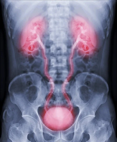 静脉注射肾小球造影 是注射造影剂后尿路X线检查 — 图库照片