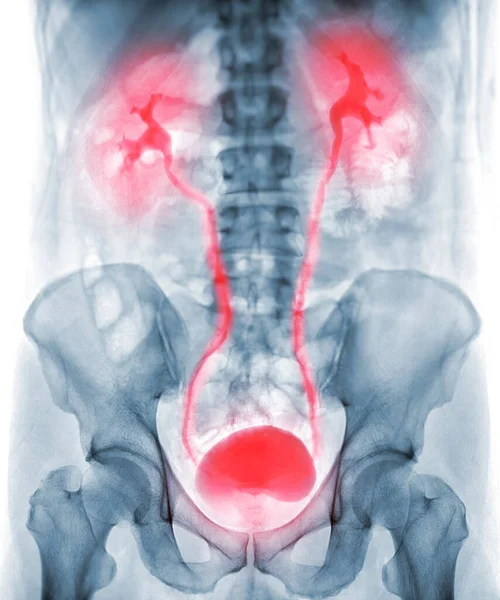 Intravenöst Pyelogram Eller Röntgenundersökning Urinvägarna Efter Injektion Kontrastmedel — Stockfoto