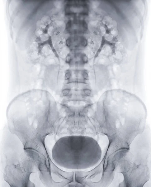 静脉注射肾小球造影 是注射造影剂后尿路X线检查 显示膀胱充盈 — 图库照片