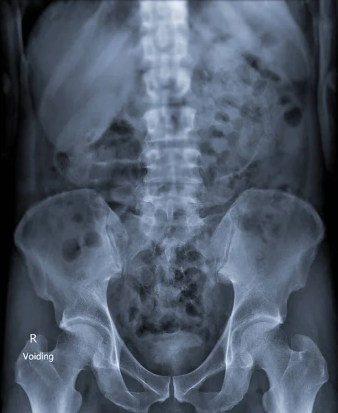 Intravenöses Pyelogramm Oder Ist Eine Röntgenuntersuchung Der Harnwege Nach Der — Stockfoto