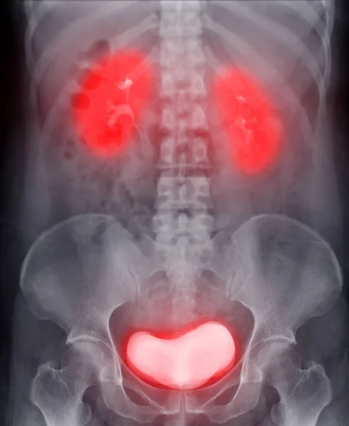 静脉注射肾小球造影 是注射造影剂后尿路X线检查 — 图库照片