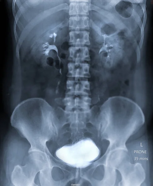 Intravenöses Pyelogramm Oder Ist Eine Röntgenuntersuchung Der Harnwege Nach Der — Stockfoto