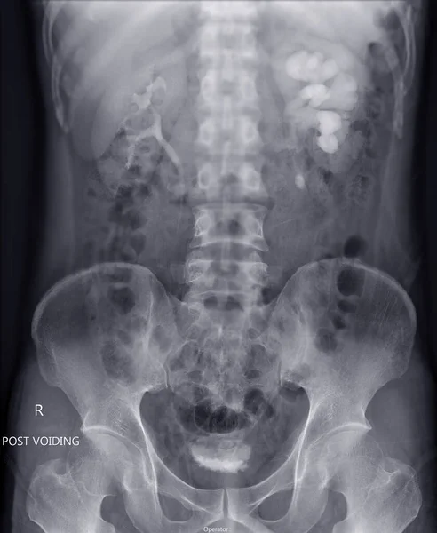 Pielogramma Endovenoso Esame Radiografico Del Tratto Urinario Dopo Iniezione Mezzo — Foto Stock