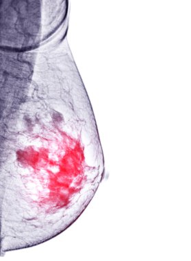  X-ray Dijital Mammogram Sağ taraf MLO görünümü. Meme kanseri için mammografi veya meme taraması BI-RADS 5; kötü huyluluğun yüksek oranda göstergesi .