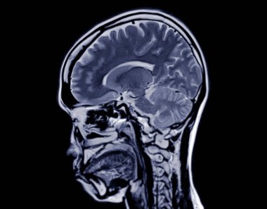 Beyin hastalıklarını tespit etmek için MRI beyin taraması sagittal düzlemi. Felç, beyin tümörleri ve enfeksiyonlar gibi..