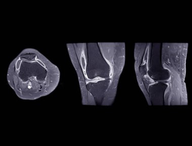 Ön çapraz bağ dokusunda yırtılma veya burkulma tespiti için diz ekseni, koronal ve sagital T2 FS 'nin manyetik rezonans görüntülemesi veya MRI' sı (ACL)