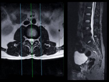 MRI L-S omurga ya da bel omurgası Eksen T2W görünümü ve omurilik sıkışması tanısı için sagittal düzlem.