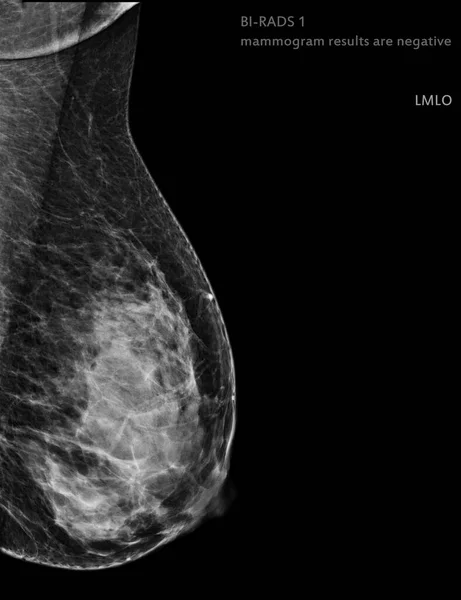 X-ray Digital Mammogram Right side MLO view . mammography or breast scan for Breast cancer BI-RADS 1 mammogram results are negative.
