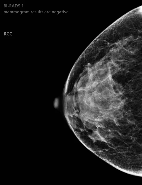 X-ray Digital Mammogram Right side CC view . mammography or breast scan for Breast cancer BI-RADS 1 mammogram results are negative.