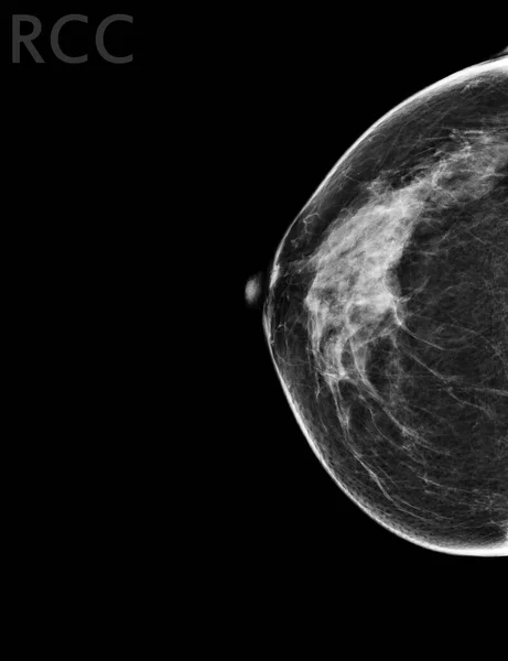X-ray Digital Mammogram Right side CC view . mammography or breast scan for Breast cancer BI-RADS 5; Highly suggestive of malignancy .