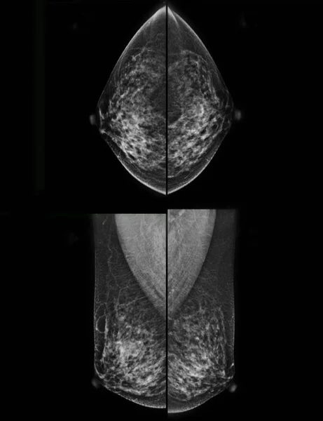 Рентгеновская Цифровая Маммограмма Mlo Маммография Сканирование Молочной Железы Рак Груди — стоковое фото