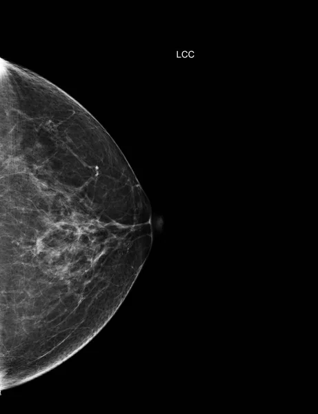 Prześwietlenie Mammografia Cyfrowa Widok Lewej Strony Mammografia Lub Skan Piersi — Zdjęcie stockowe
