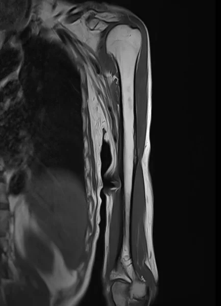Mri Kemik Tümörü Teşhisi Için Humerus Kemiği Bıraktı — Stok fotoğraf