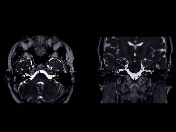 Rezonans Magnetyczny Mózgu Wewnętrznym Kanałem Słuchowym Iac Widok Osiowy Koronalny — Zdjęcie stockowe