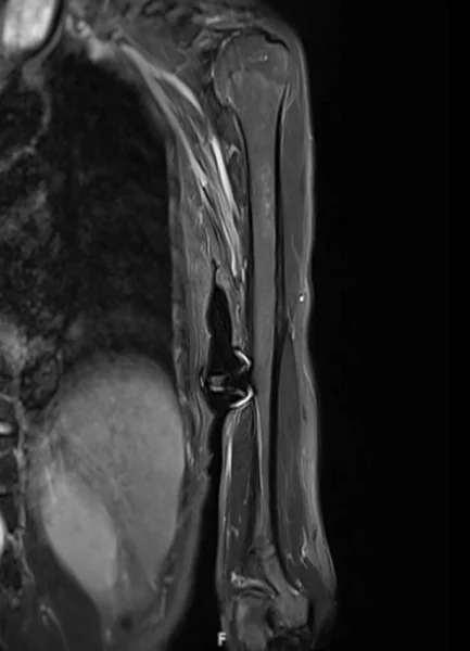 骨腫瘍を診断するためのMri左ユーモラス骨 — ストック写真