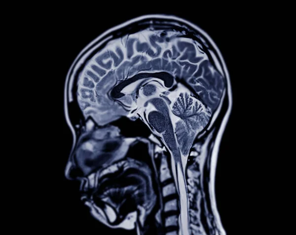 Beyin Hastalıklarını Tespit Etmek Için Mri Beyin Taraması Sagittal Düzlemi — Stok fotoğraf