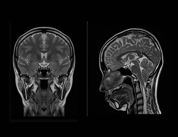 Сравнение Корональной Сагиттальной Плоскостей Выявления Заболеваний Головного Мозга Таких Инсульт — стоковое фото