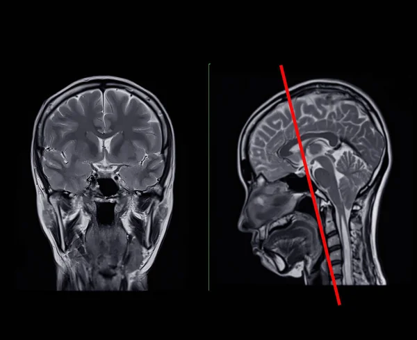 Mri Skanowania Mózgu Porównaj Coronal Sagittal Płaszczyzny Wykrywania Chorób Mózgu — Zdjęcie stockowe