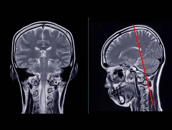 Mri脑扫描比较冠状和矢状平面对脑卒中 脑肿瘤和感染等脑病的诊断 — 图库照片