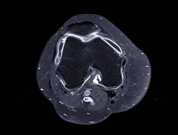 Ressonância Magnética Ressonância Magnética Articulação Joelho Vista Axial Com Gadolínio — Fotografia de Stock