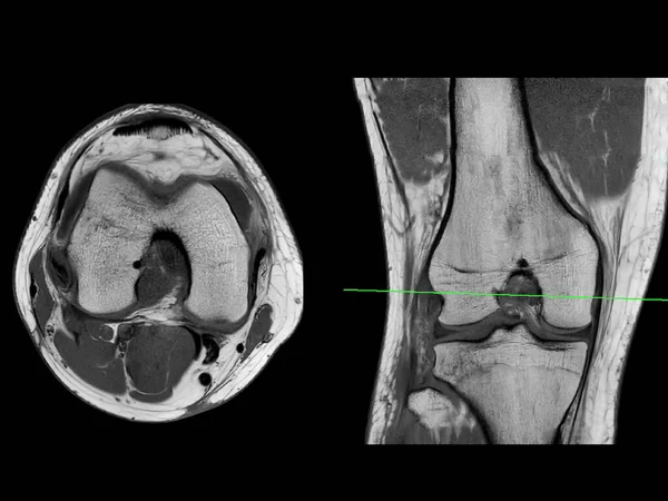膝関節Axial T2およびコロナビューの磁気共鳴イメージングまたはMri 前十字靭帯の涙または脊柱を検出するための — ストック写真
