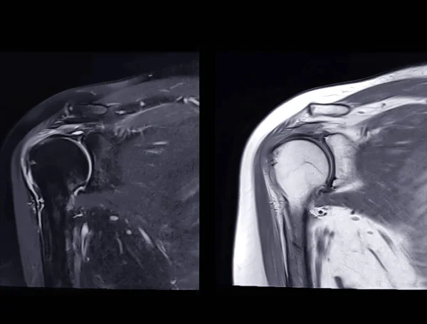 Imágenes Por Resonancia Magnética Resonancia Magnética Articulación Del Hombro Coronal — Foto de Stock