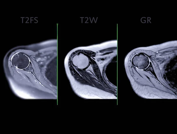 Imágenes Por Resonancia Magnética Resonancia Magnética Articulación Del Hombro T2Fs — Foto de Stock