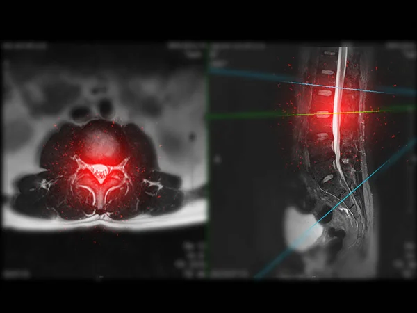Mri Spine Lumbar Spine Axial T2W View Sagittal Plane Diagnosis — Stockfoto