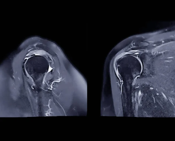 Magnetic Resonance Imaging or MRI of Shoulder Joint Sagittal and Coronal T2 FS  for diagnostic shoulder pain.