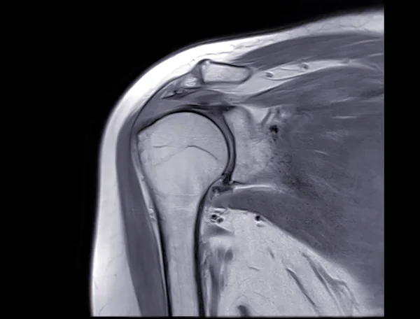 Imagem Ressonância Magnética Articulação Ombro Coronal Pdw Para Diagnóstico Dor — Fotografia de Stock