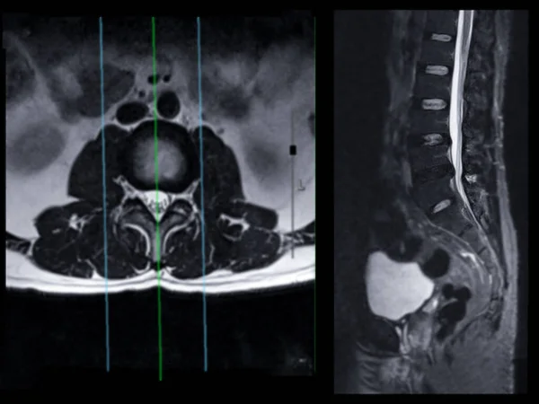 Mri Spine Lumbar Spine Axial T2W View Sagittal Plane Diagnosis — ストック写真