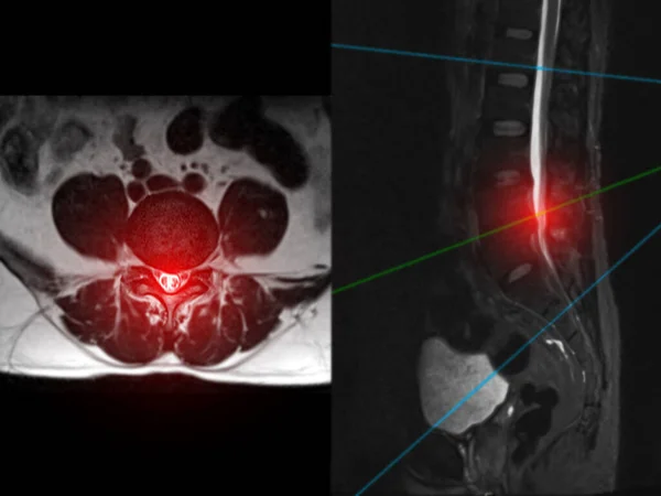 Mri Spine Lumbar Spine Axial T2W View Sagittal Plane Diagnosis — 스톡 사진