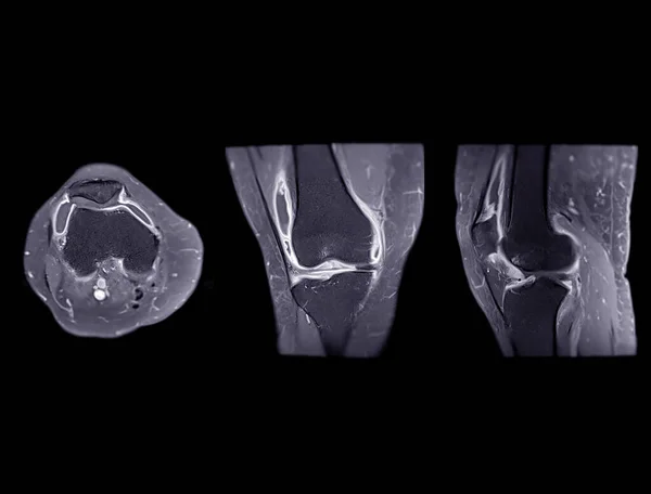 Magnetic Resonance Imaging Mri Knee Joint Axial Coronal Sagittal Detect — Stock Photo, Image