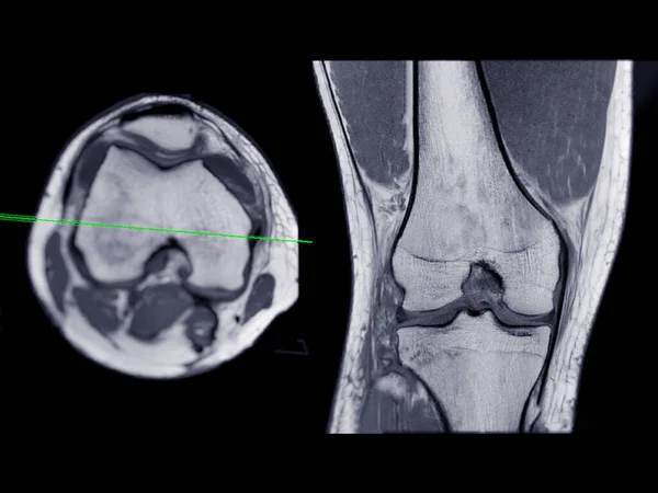Rezonans Magnetyczny Lub Rezonans Magnetyczny Stawu Kolanowego Osiowy Coronal View Obraz Stockowy