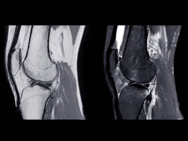 Magnetic Resonance Imaging Mri Knee Joint Sagittal Pdw Detect Tear — Stock Photo, Image