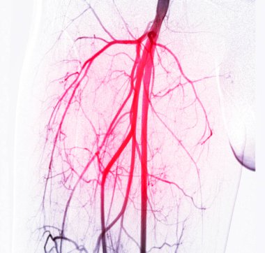 Femoral artery angiogram or angiography  clipart