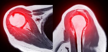 Omuz Eklemleri 'nin tanısal omuz ağrısı için manyetik rezonans görüntülemesi veya MRI' sı.