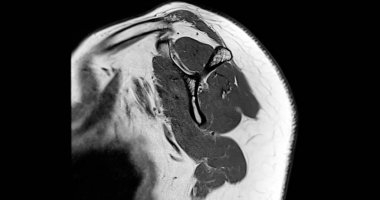 Omuz Eklemleri 'nin tanısal omuz ağrısı için manyetik rezonans görüntülemesi veya MRI' sı.
