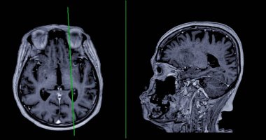 MRI beyin taraması ve beyin hastalıklarını tespit etmek için referans hattı ile sagital görüş felç, beyin tümörleri ve enfeksiyonlar gibi sush.