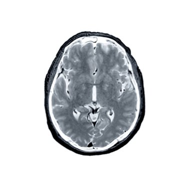 Beyin hastalıklarını tespit etmek için MRI beyin taraması ekseni görüntüsü felç, beyin tümörleri ve enfeksiyonlar gibi sush.
