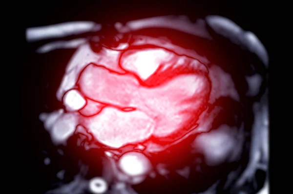 Resonancia Magnética Resonancia Magnética Del Corazón Vista Cámaras Para Diagnóstico — Foto de Stock