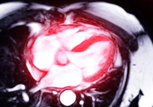 心臓のMri心臓または心臓Mri 磁気共鳴イメージング 診断心臓病のための4室ビュー — ストック写真