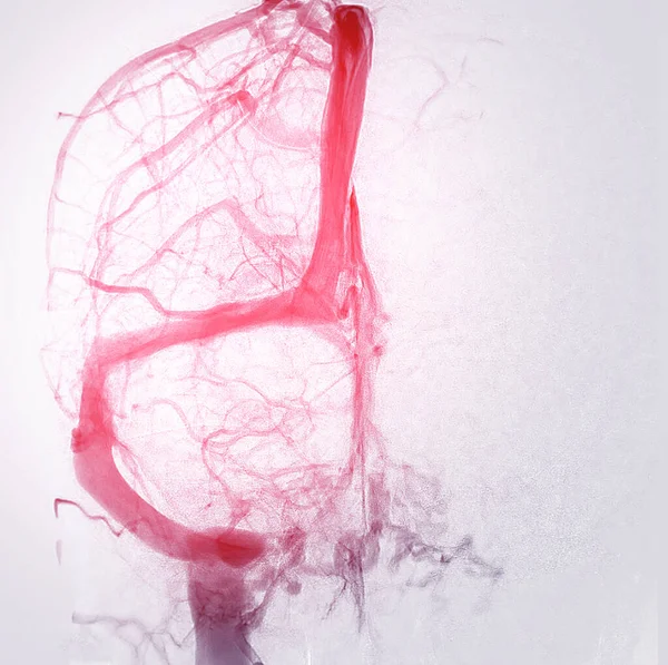 Cerebral Angiography Image Fluoroscopy Intervention Radiology Showing Cerebral Artery — Photo