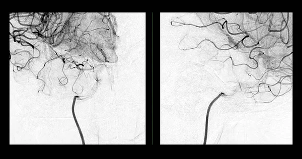 Cerebral Angiography Image Fluoroscopy Intervention Radiology Showing Cerebral Artery — Foto de Stock