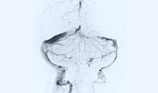 Cerebral Angiography Image Fluoroscopy Intervention Radiology Showing Cerebral Artery — Stock Photo, Image