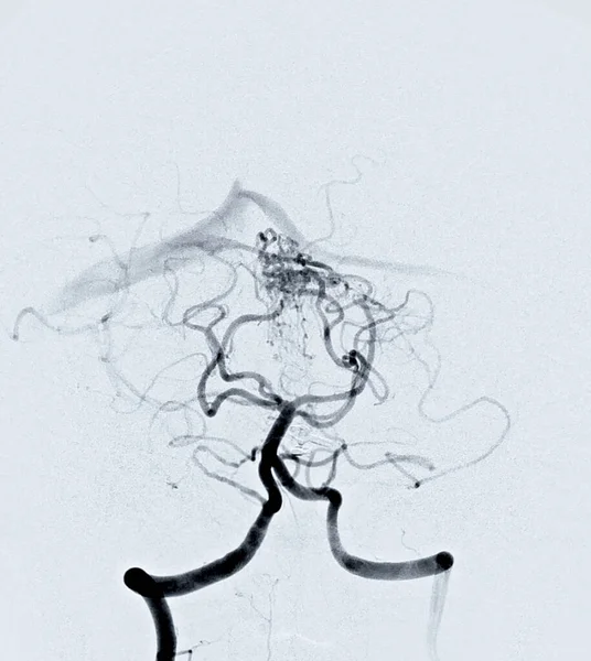 Cerebral Angiography Image Fluoroscopy Intervention Radiology Showing Cerebral Artery — Zdjęcie stockowe